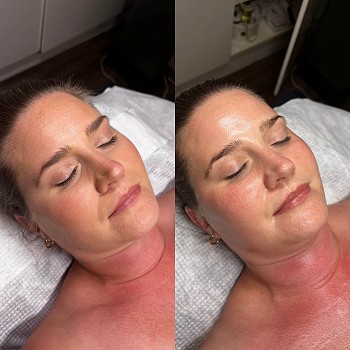 Glass Skin Treatment Explained