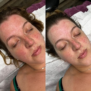Omega Green PDT Treatment Explained